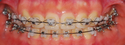 오라픽스 치아교정 포스팅 (8).jpg