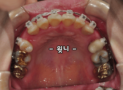 99윗니.gif