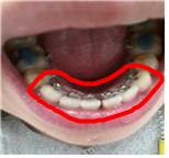 교정 월치료 날 하악사진.jpg