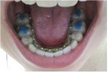 월치료 일주일 후 하악사진.jpg