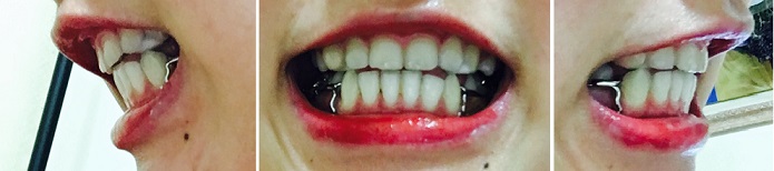 교정후기 22_1.jpg