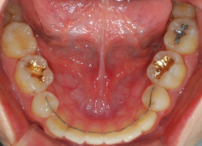 오라픽스 치아교정 포스팅(8).jpg