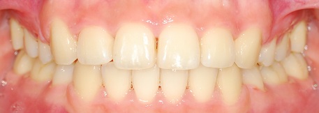 오라픽스 치아교정 포스팅(4).jpg