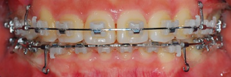 오라픽스 치아교정 포스팅 (4).jpg