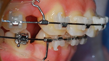 오라픽스 치아교정 포스팅 (5).jpg