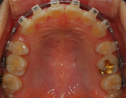 오라픽스 치아교정 포스팅 (6).jpg