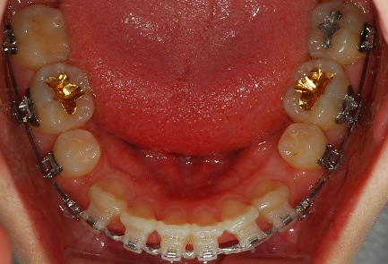 오라픽스 치아교정 포스팅 (7).jpg