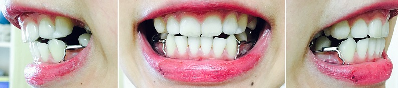 교정후기 17_2.jpg