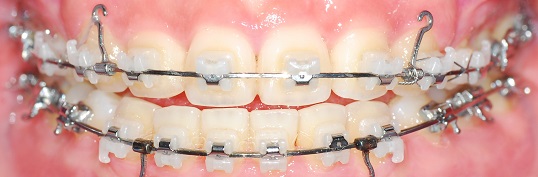 오라픽스 치아교정 포스팅(5).jpg