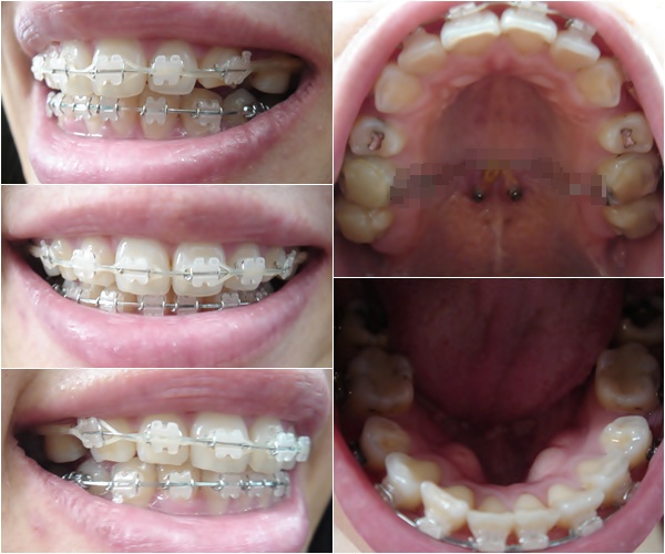 18. 킬본교정.jpg