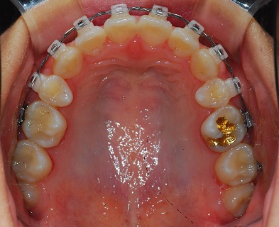 오라픽스 치아교정 포스팅 (4).JPG