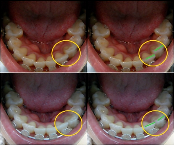 27. 킬본교정 (12).jpg
