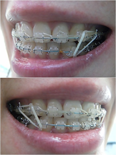 27. 킬본교정 (2).jpg