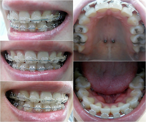 27. 킬본교정.jpg