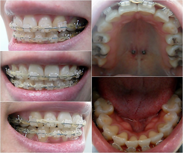 26. 킬본교정.jpg