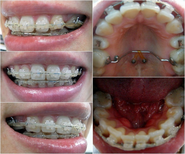 21.킬본교정 (6).jpg