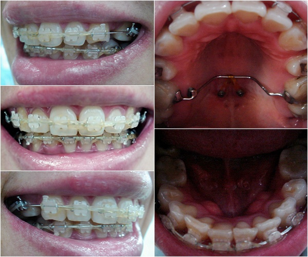 21.킬본교정 (5).jpg