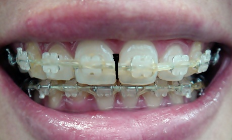 21.킬본교정 (3).JPG