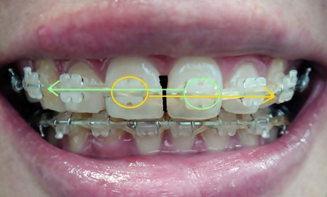 21.킬본교정 (4).JPG