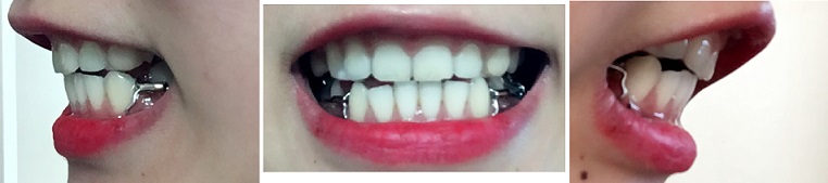 교정후기 20_2.jpg