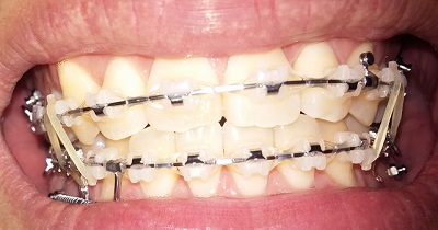 턱관절치아교정후기26화사진2.jpg