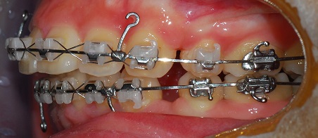 오라픽스 치아교정 포스팅(1).jpg