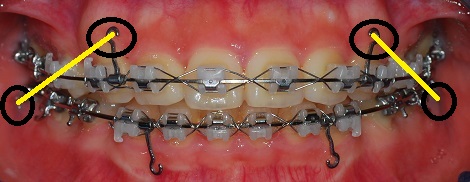 오라픽스 치아교정 포스팅(12).jpg