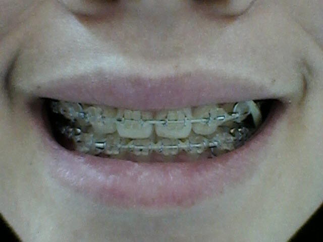 어금니 물고.jpg