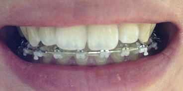 치아교정후기1.JPG