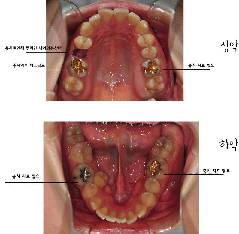 치아교정후기3.jpg