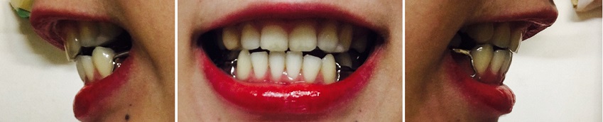 교정후기 19_1.jpg