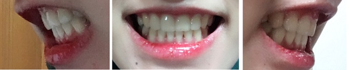 교정후기 40_1.jpg