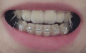 치아교정후기3.jpg