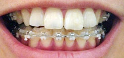 치아교정후기1.jpg