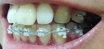 치아교정후기3.jpg