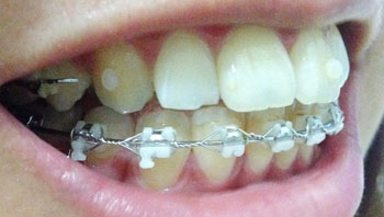 치아교정후기4.jpg
