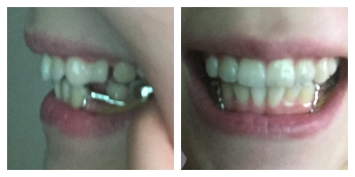 150629 교정후기1.jpg