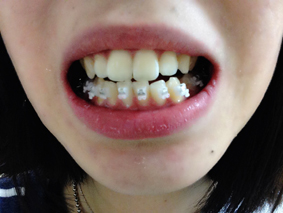 치아교정후기4.JPG
