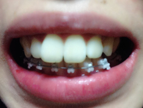 치아교정후기8.JPG
