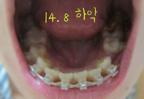 치아교정후기07.jpg