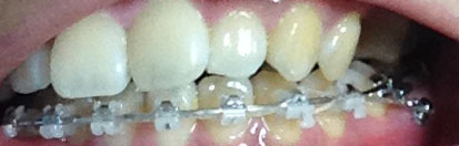 치아교정후기09.JPG