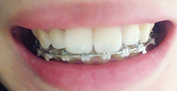 치아교정후기01.JPG