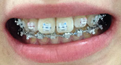 치아교정후기1.JPG