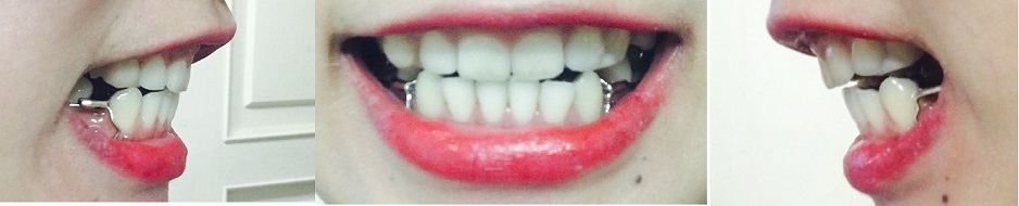 교정후기 18_1.jpg