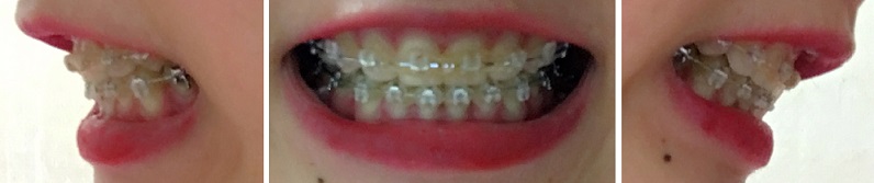 교정후기 35_1.jpg